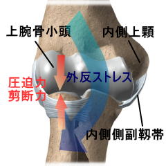 上腕骨小頭離断性骨軟骨炎