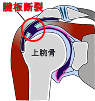 腱板断裂