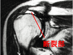 腱板断裂のMRI