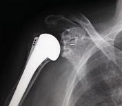 人工肩関節置換術
