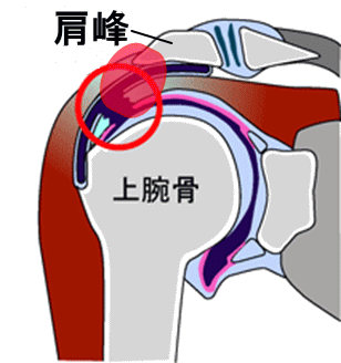 腱板断裂