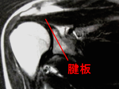 肩のMRI